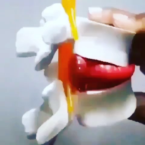 #discherniation #nervepain A common condition that can affect the whole vertebral column but most commonly the lumbar and cervical spine. Symptoms could include,numbness,tingling,pins and needles and weakness. Generalis…