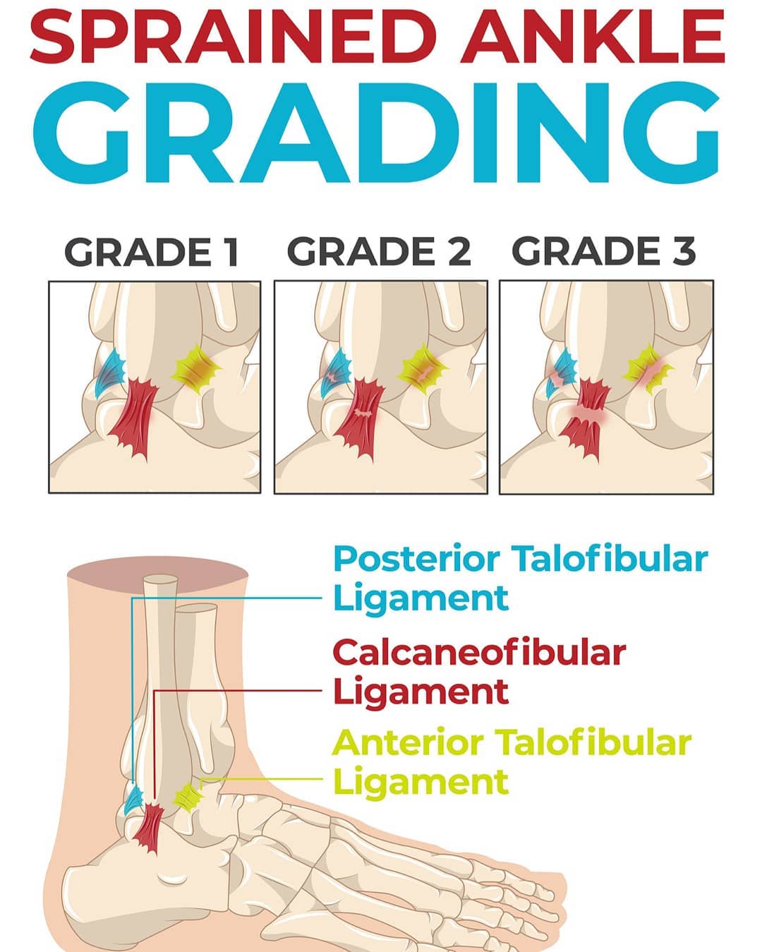 #anklesprain #ankle #sprain Grades of ankle sprain..identification of the grade is key in rehab and return to sport..