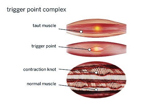 Many patients ask me what’s a trigger point(Knots).. In brief a repeated muscle contraction which doesn’t quite relax..it’s quite layman the way I’m explaining but the message will be put through.. #knots#triggerpoint#m…