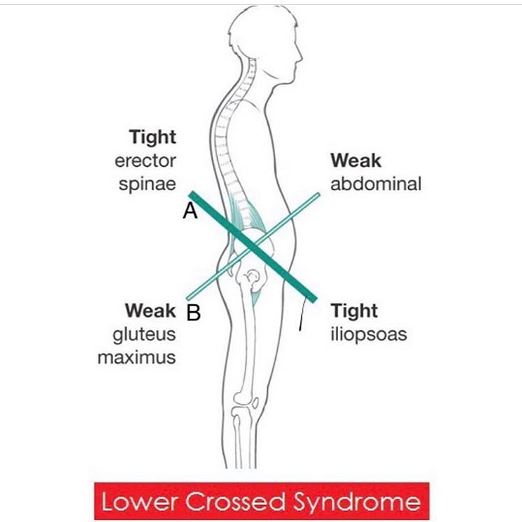 #posture#pelvictilt#hip#neurokinetictherapy#nkt A NKT therapist can surely fix this..