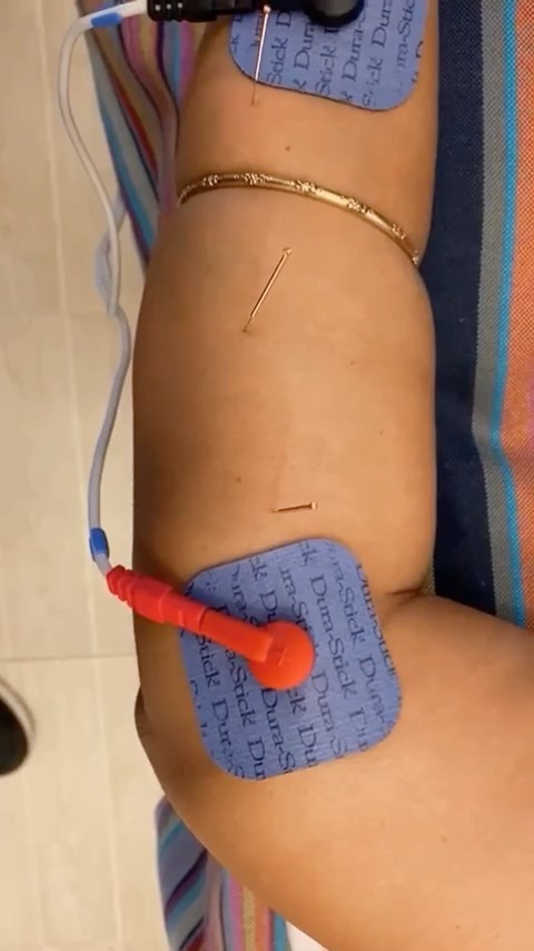 This patient approached me with a concern of pain and numbness down her arm so we used dry needling and electromagnetic stimulation to promote blood flow and improve muscle function . . . . . . #Mombasani #mombasachiro…